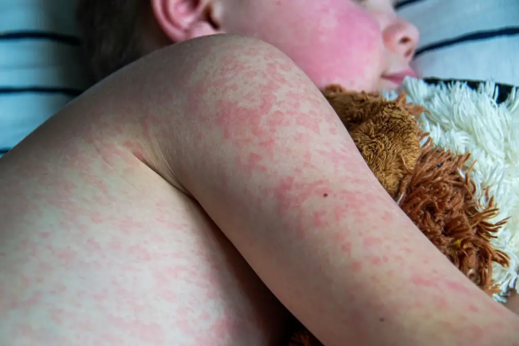 Blog Young Child With Measles